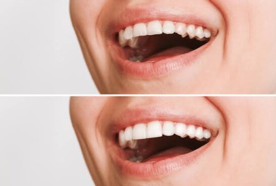 5 Ways Crowns And Veneers Work Together For Natural Smiles